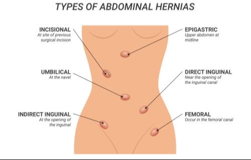 types of abdominal wall hernias 500