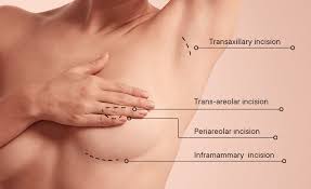 breast incisions