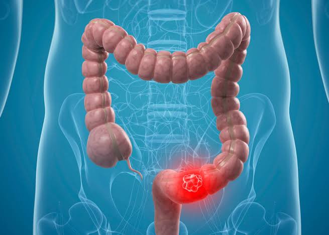 colon cancer 2
