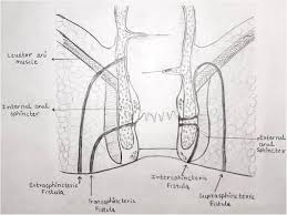 fistula