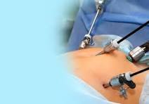 laparoscopy 1