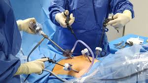 laparoscopy