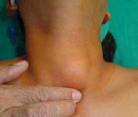 thyroid lump