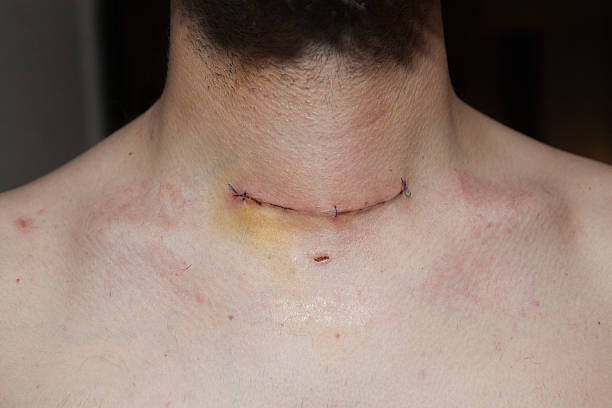 thyroid gland sfter surgery scar