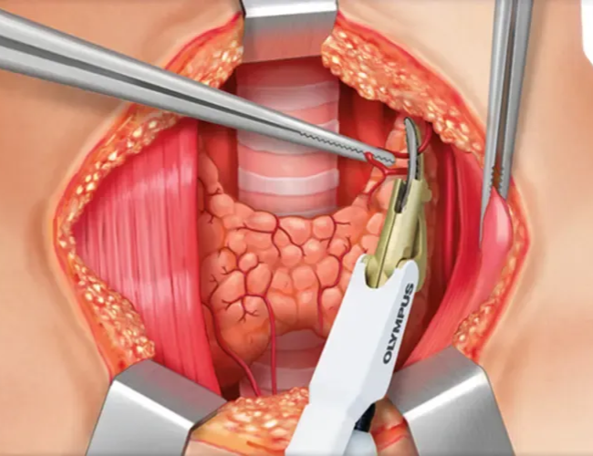 thyroidectomy