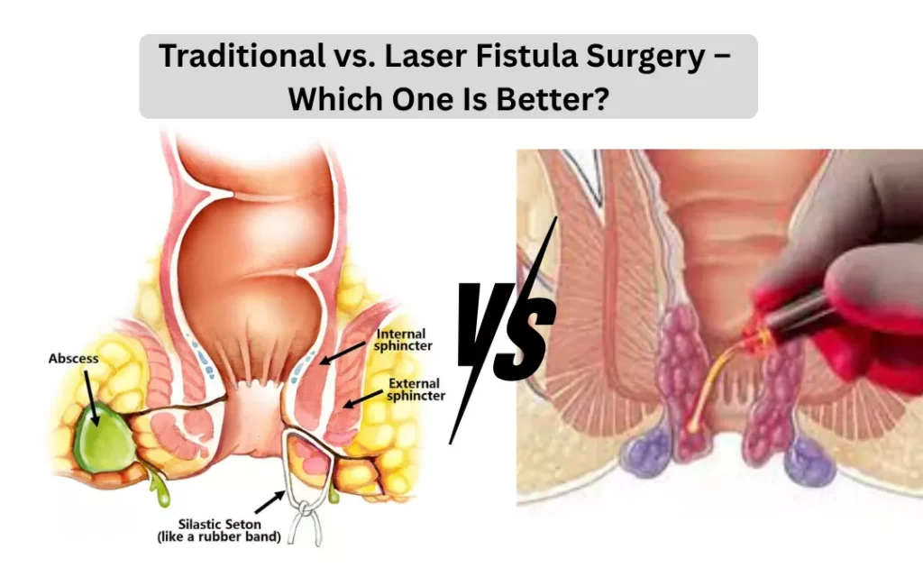 traditional vs laser fistula surgery which one is better