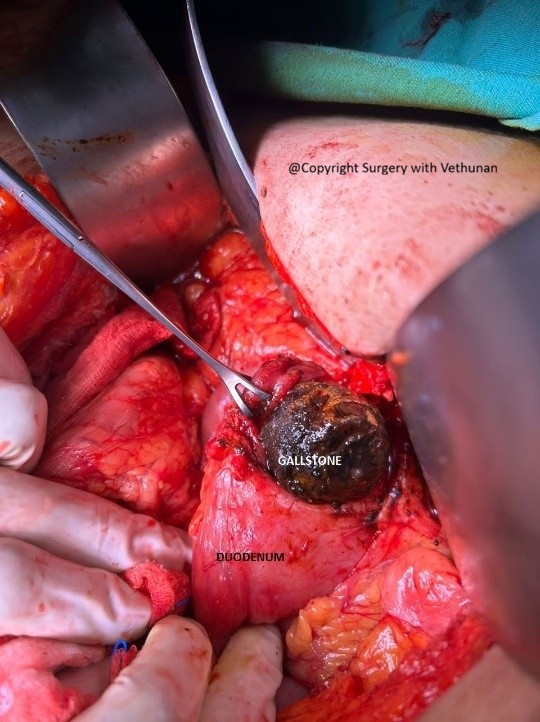 bouverete syndrome