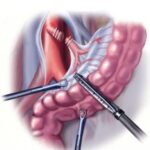 colon surgery