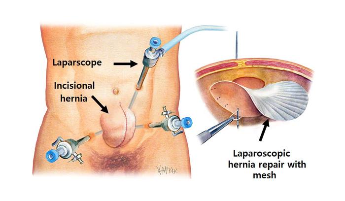 hernia repair