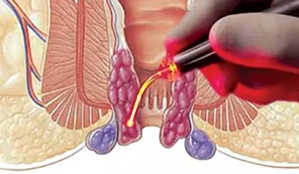 laser hemorrhoid
