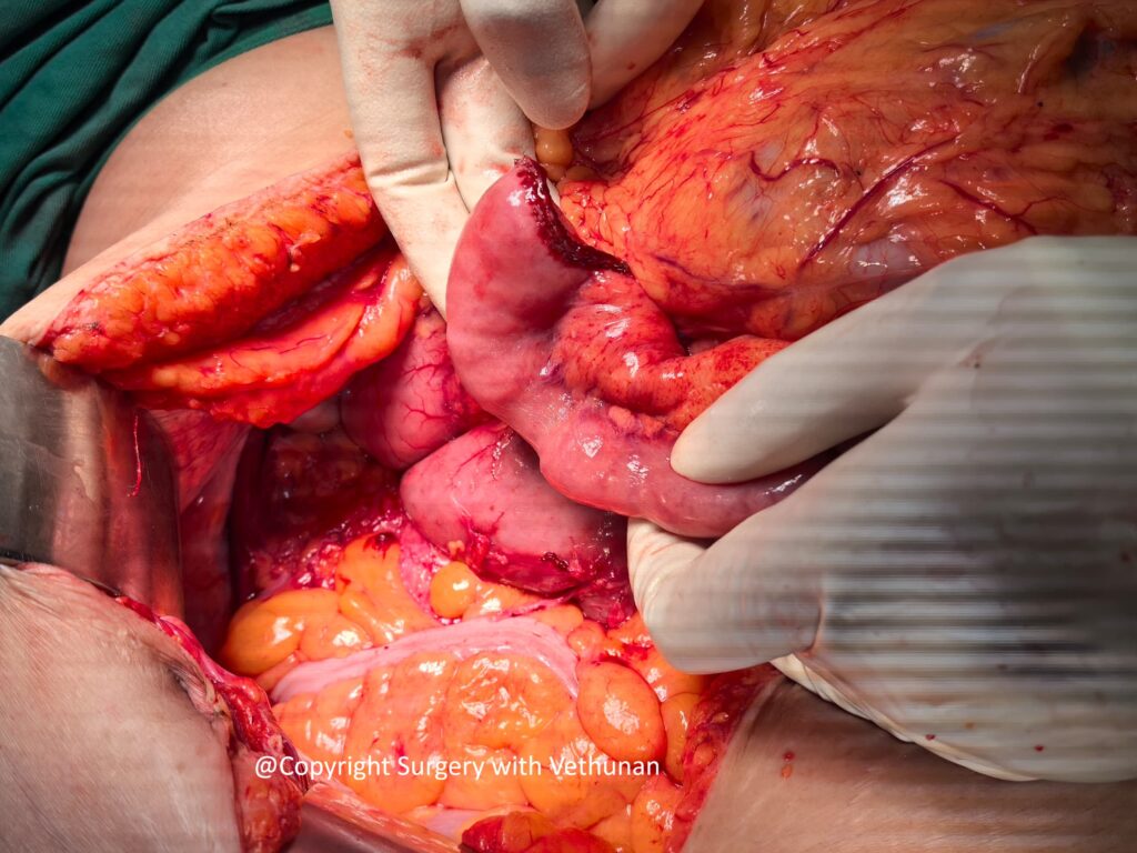 duodenal tumor 2