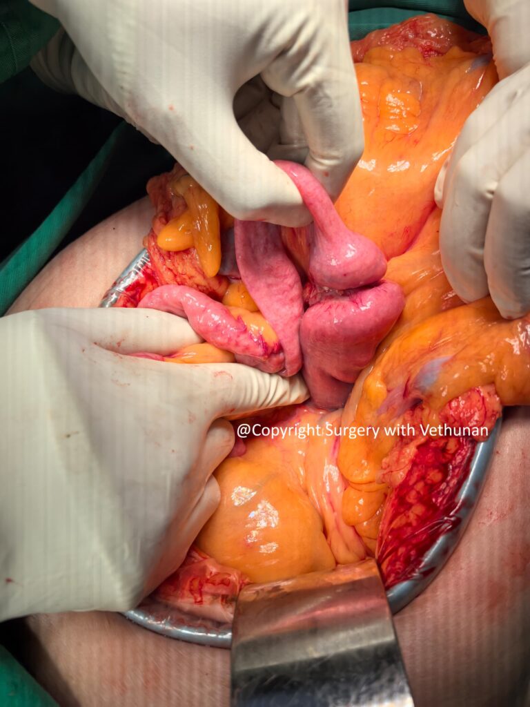 duodenal tumour 1