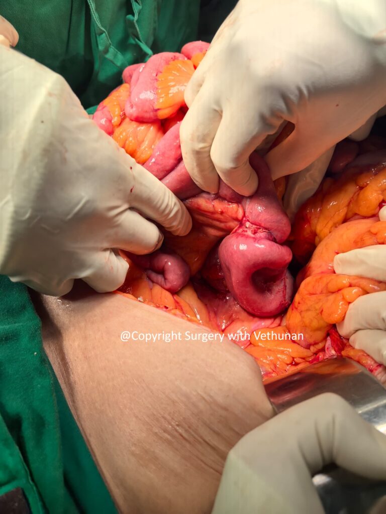 duodenal tumour 3