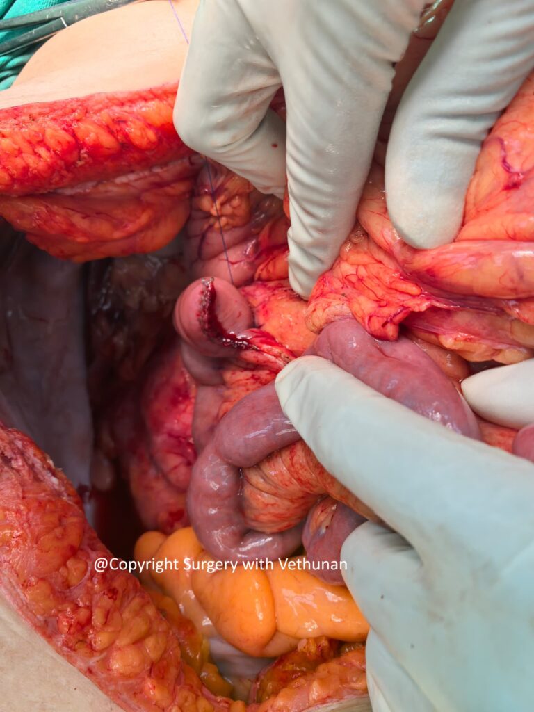 duodenal tumour 4
