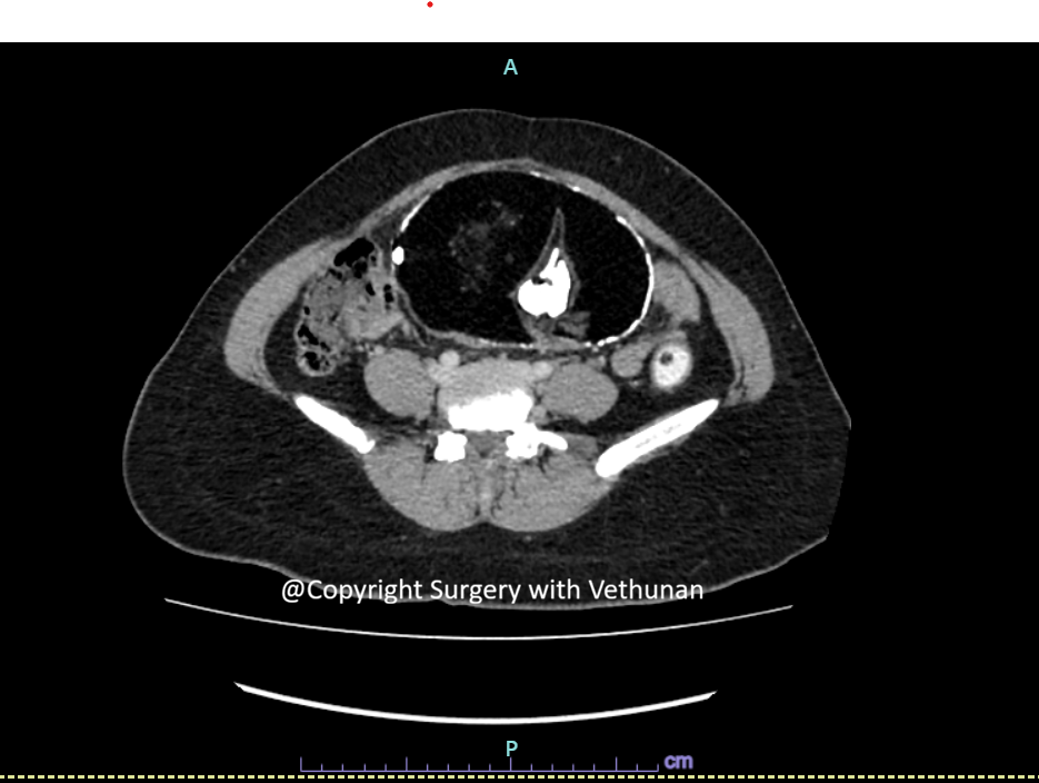 mesenteric teratoma 1