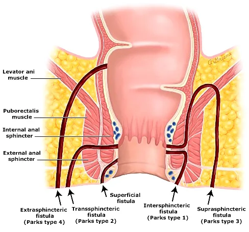 parks classification of anal fistula