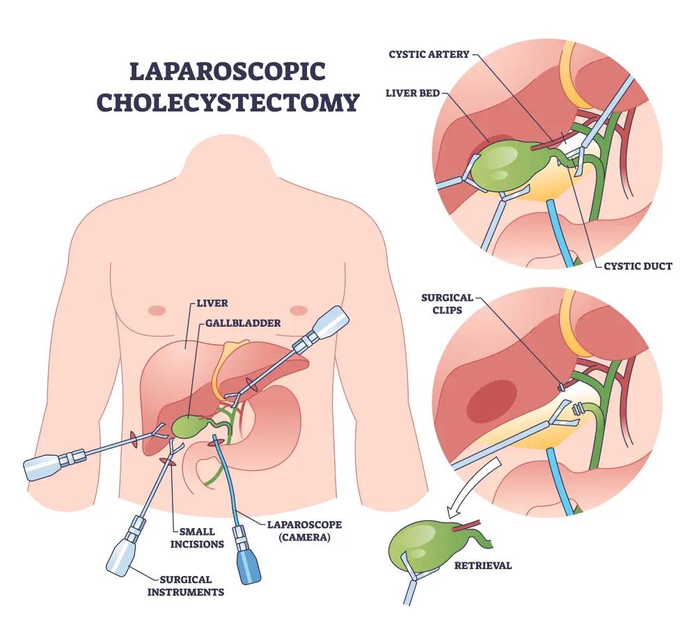 gallbladder 4